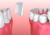 Dental Veneers vs. Dental Crowns