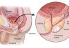 Men it is time for you to take your prostate health seriously