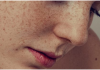 What are the causes of acne that keep you far from enjoying clean, beautiful skin?
