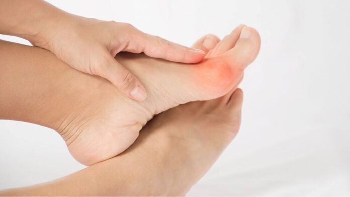 Bunions vs. Big Toe Arthritis
